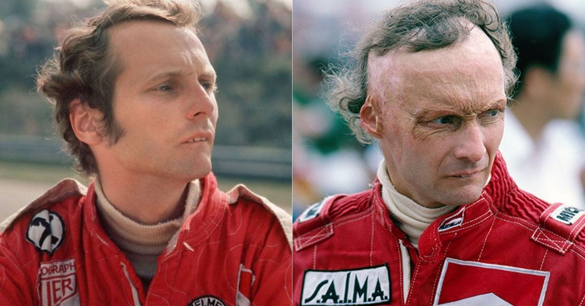 Niki Lauda before his accident and after his accident